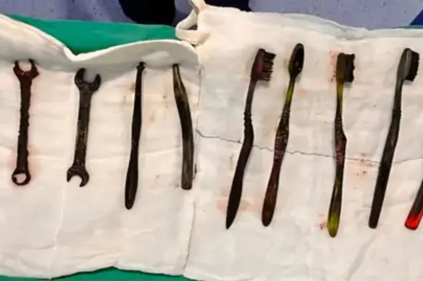 இளைஞர் வயிற்றில் இரும்பு ஸ்பேனர்கள்.. மருத்துவர்கள் அதிர்ச்சி!